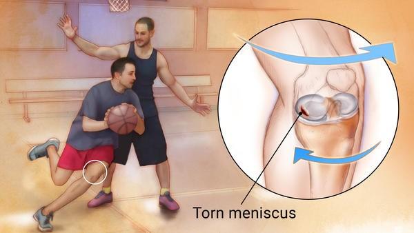 Meniscus sérülés