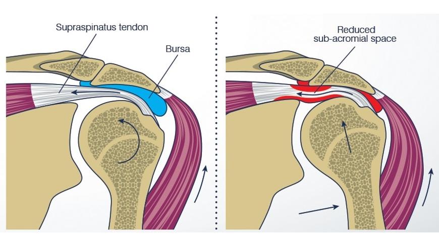 a csípőízületek deformáló osteoarthrosisának 2 fokos kezelése